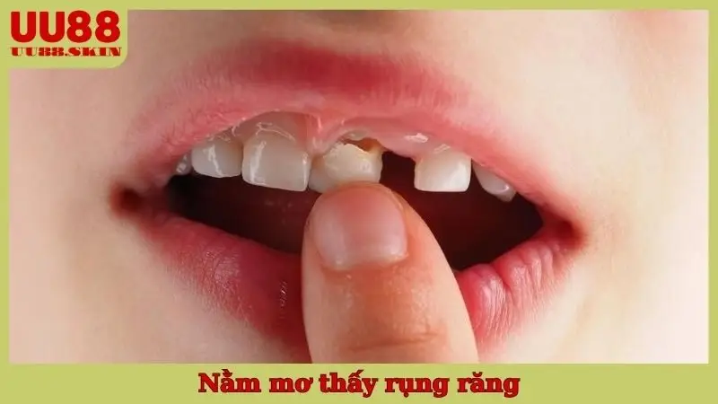 Nằm Mơ Thấy Rụng Răng